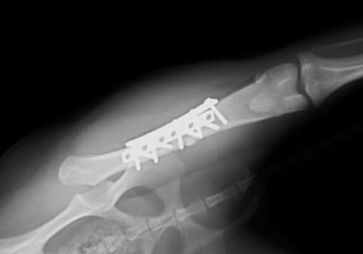 骨折手術前のレントゲン写真2