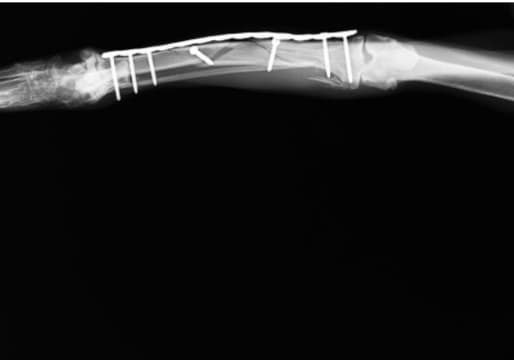 骨折手術前のレントゲン写真3